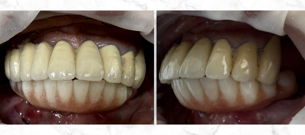 all-on-4 成果展現