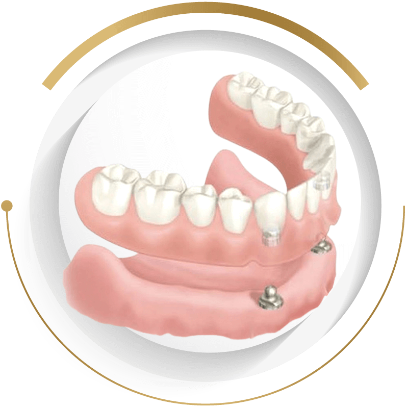 至維牙醫診所_半固定鈕扣式活動假牙