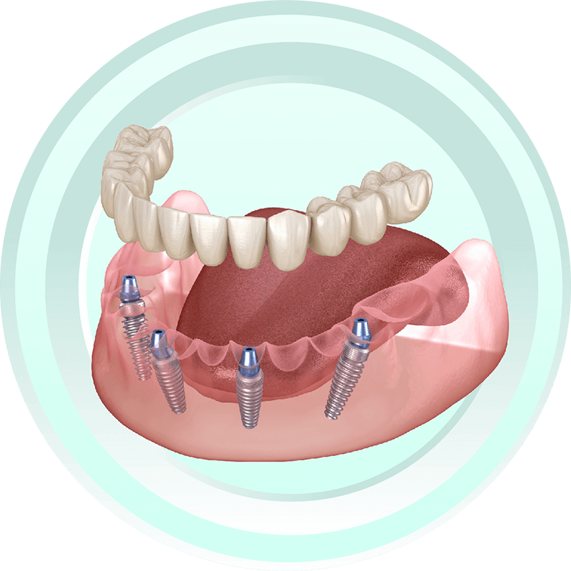 至維牙醫診所_全口重建 All-on-4 / All-on-6