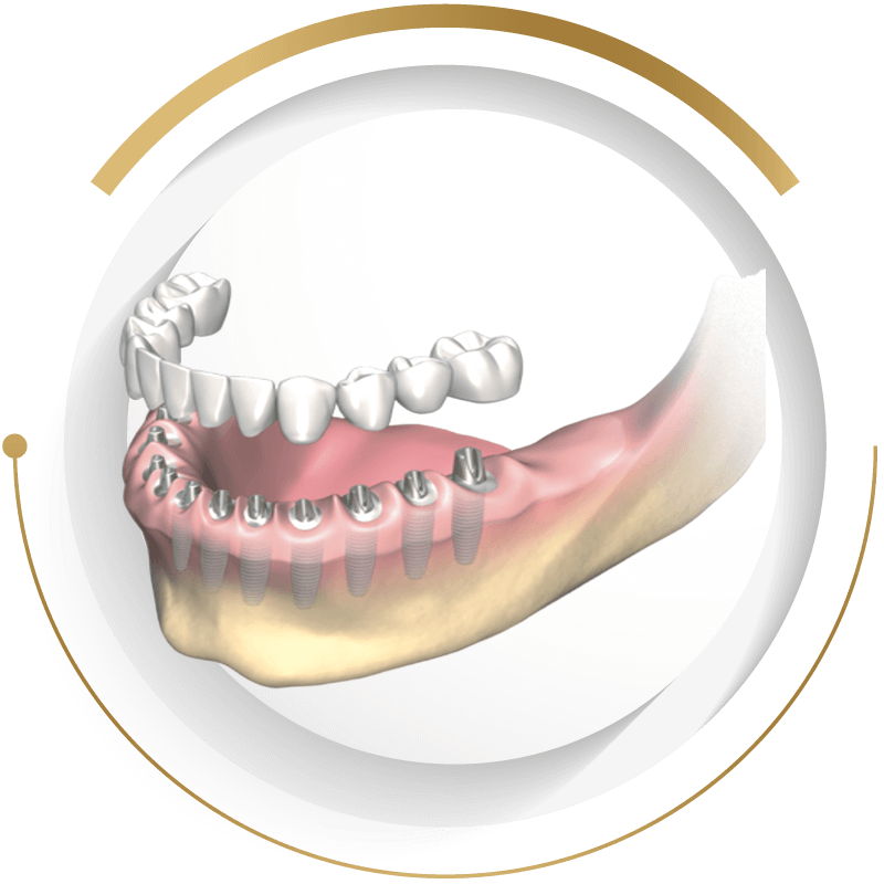 至維牙醫診所_全口植牙