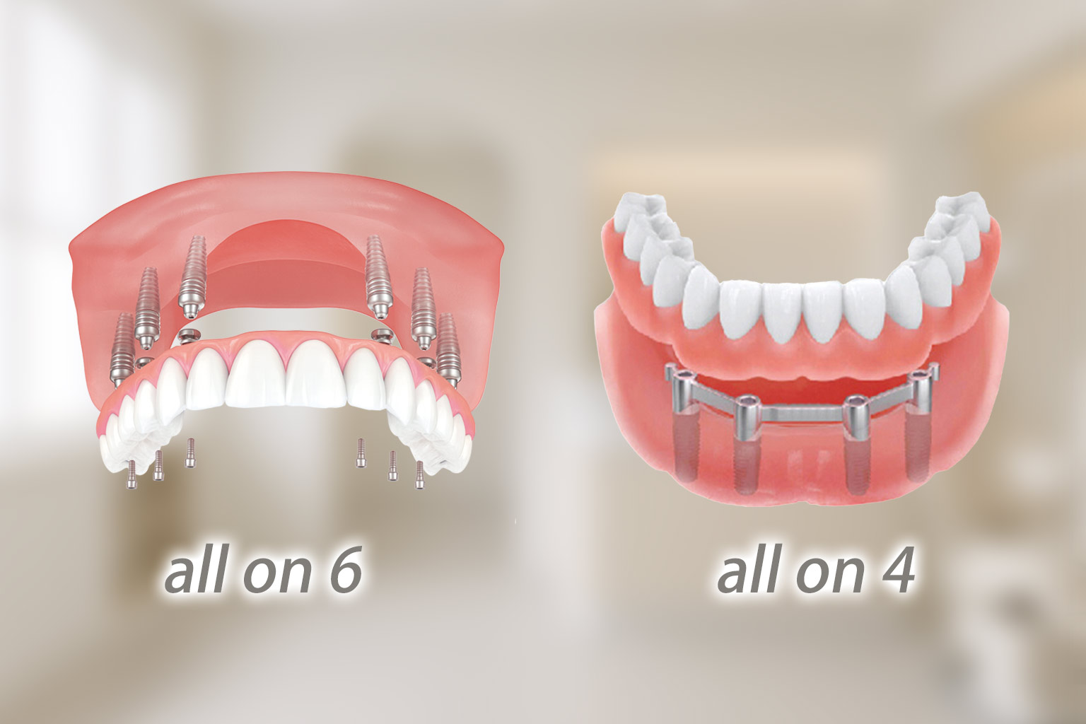 ALL-ON-4、ALL-ON-6全口植牙全面解析：原理、流程、適合對象