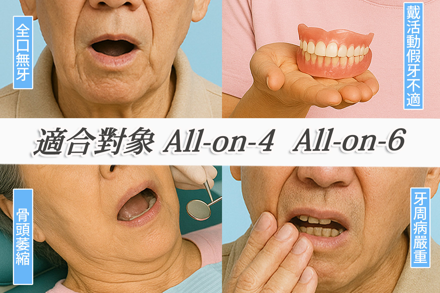 All-on-4 與 All-on-6 植體分佈示意圖