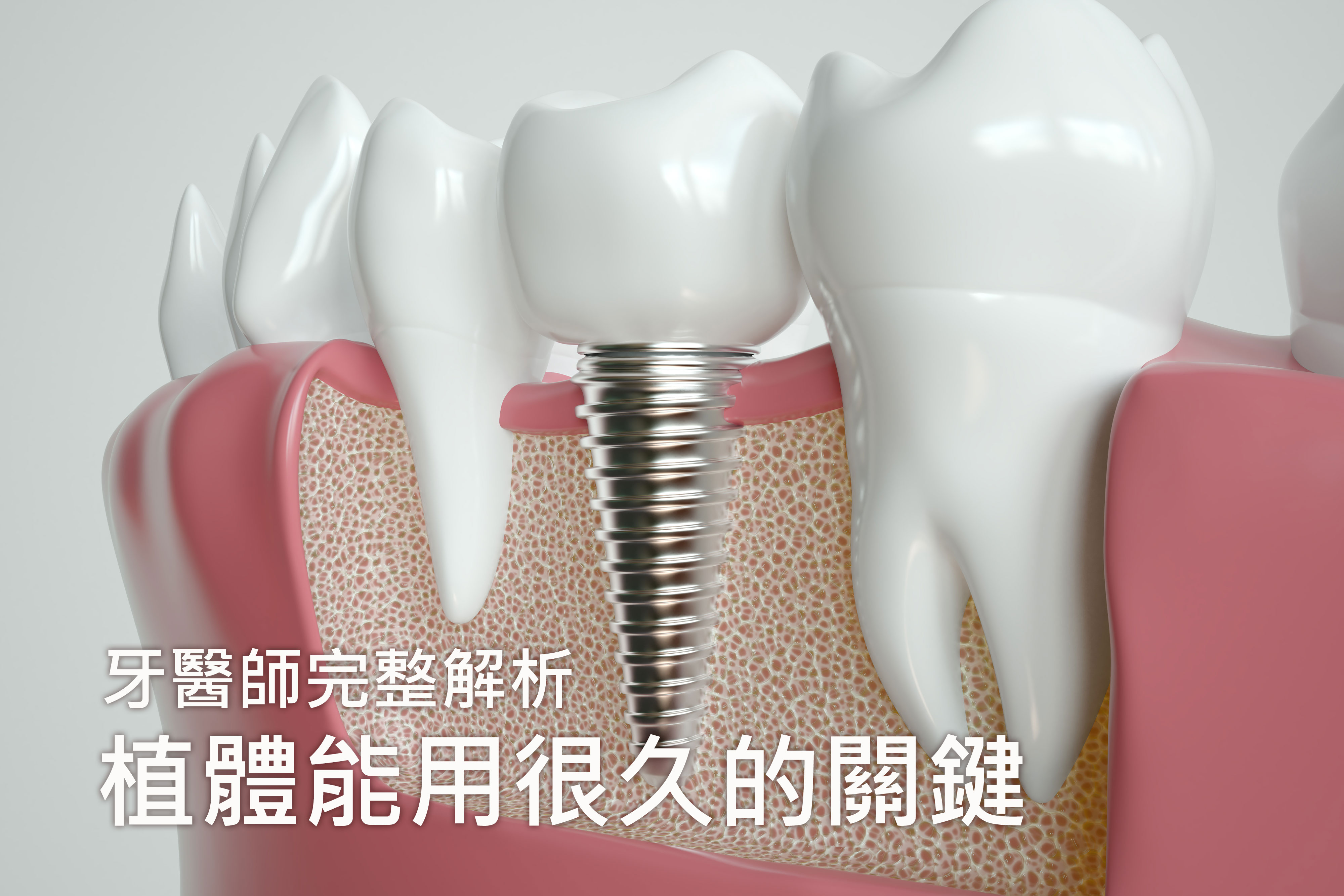 為什麼有些植體能用10年沒事，有些卻鬆動？牙醫師完整解析