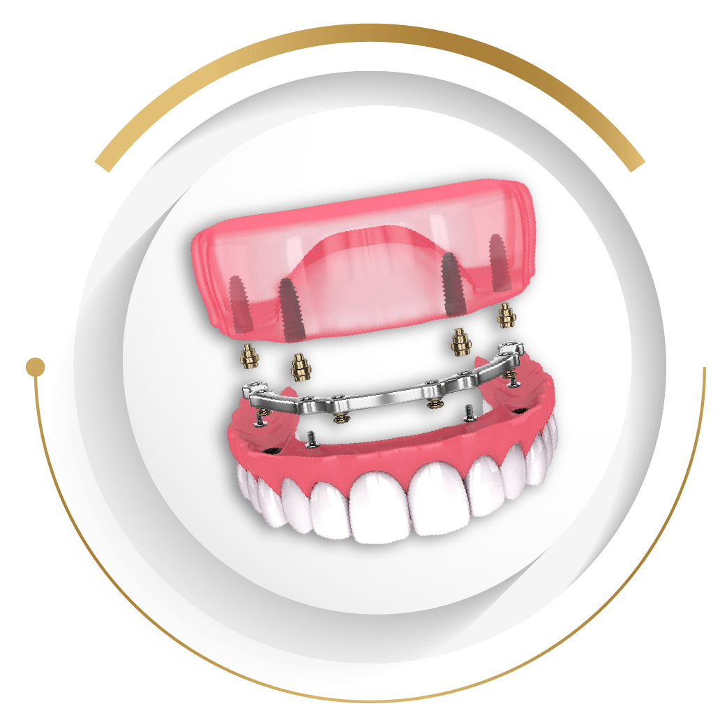 至維牙醫診所_全口重建_All-on(4~6)全口植牙