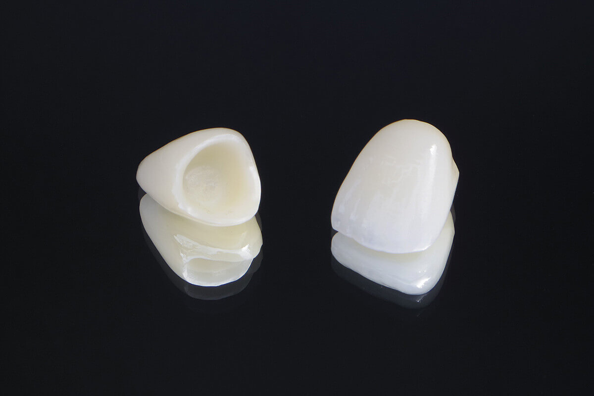 至維牙醫診所_全鋯假牙冠是什麼材質？