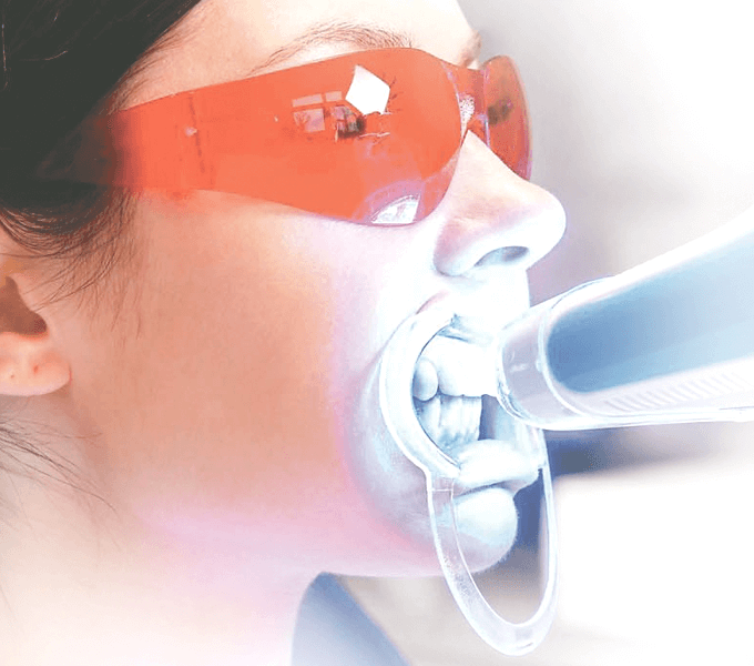 至維牙醫診所_牙齒冷光美白